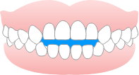 開咬のイラスト