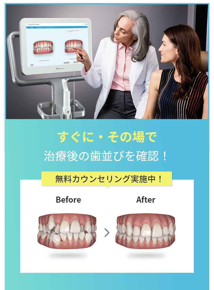 すぐに・その場で治療後の歯並びを確認！無料カウンセリング実施中BeforeAfter