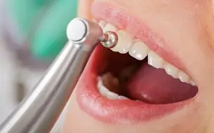 STEP2.歯のクリーニング